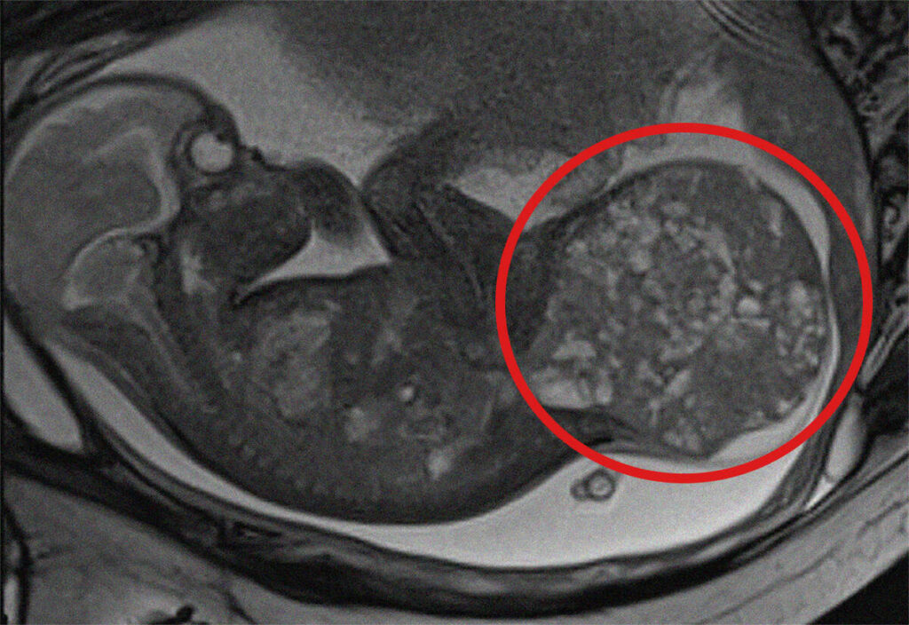 BIMBA CON TUMORE DI 800 GRAMMI: SALVATA GRAZIE AL BAMBINO GESU’