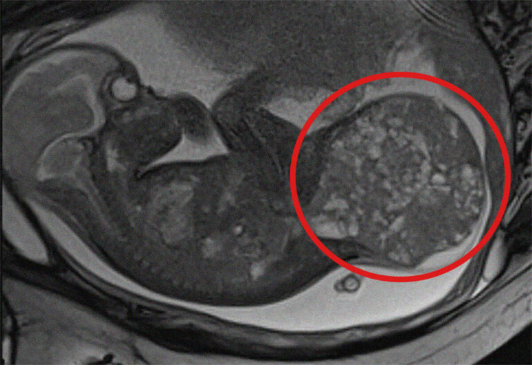 BIMBA CON TUMORE DI 800 GRAMMI: SALVATA GRAZIE AL BAMBINO GESU’