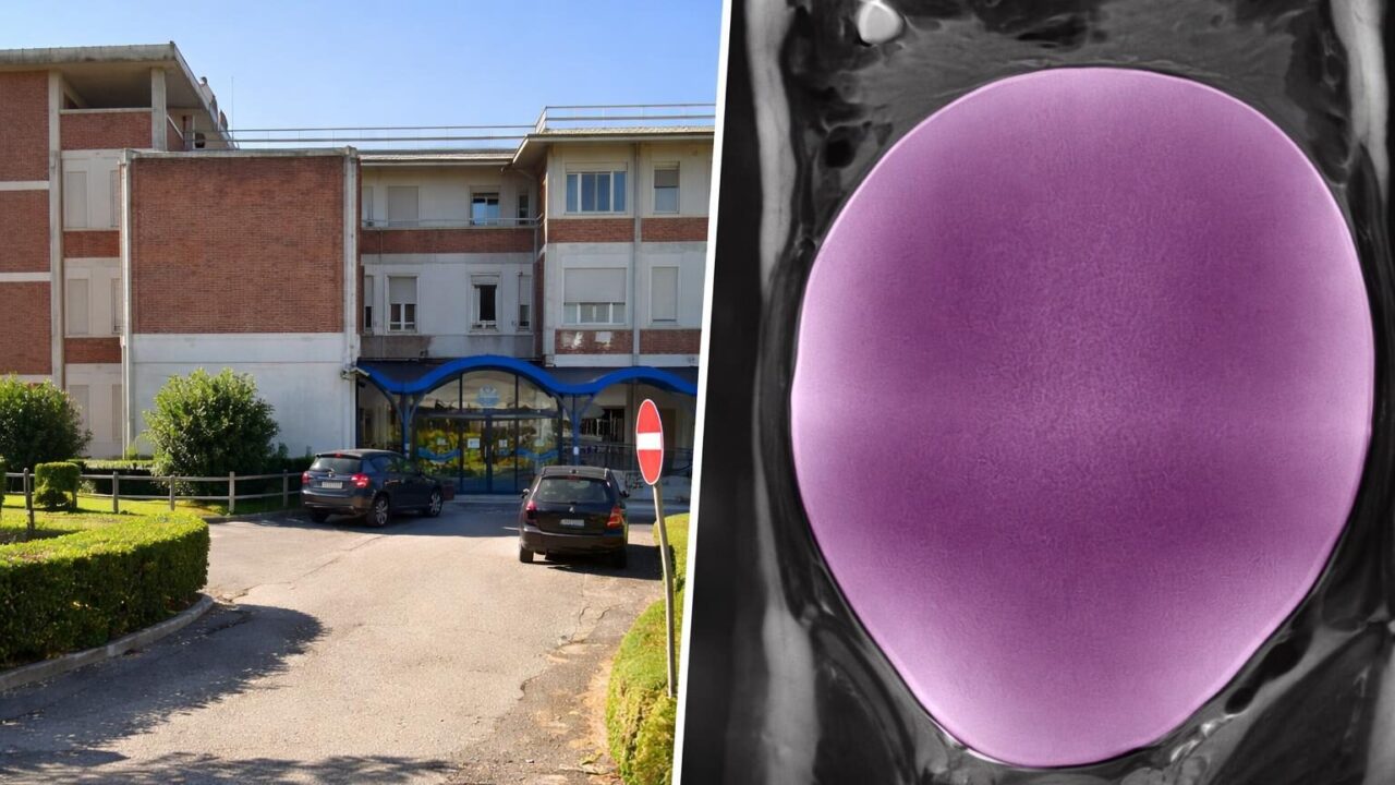 Intervento straordinario su cisti ovarica di 7 chili: un campanello d’allarme per la salute giovanile