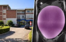 Intervento straordinario su cisti ovarica di 7 chili: un campanello d’allarme per la salute giovanile