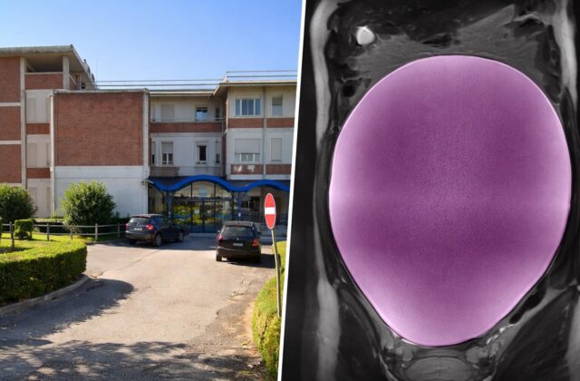 Intervento straordinario su cisti ovarica di 7 chili: un campanello d’allarme per la salute giovanile
