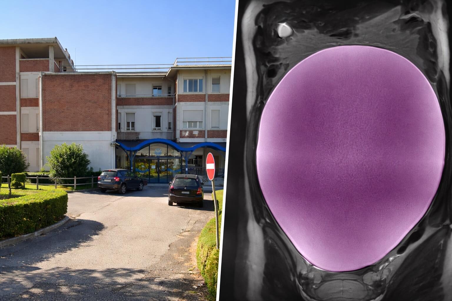 Intervento straordinario su cisti ovarica di 7 chili: un campanello d'allarme per la salute giovanile