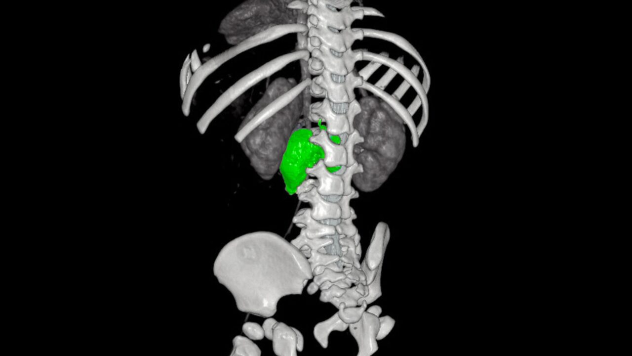 Chirurgia su misura, al Bambino Gesù di Roma rimosso complesso neuroblastoma a bimba di 1 anno