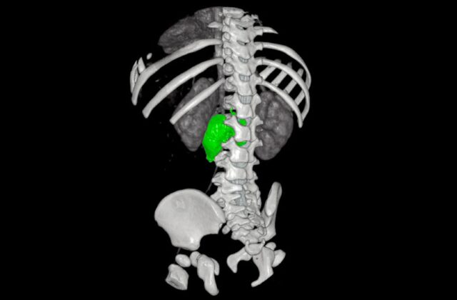 Chirurgia su misura, al Bambino Gesù di Roma rimosso complesso neuroblastoma a bimba di 1 anno